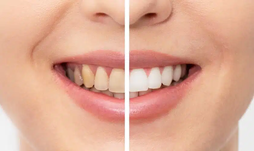 best whitening toothpaste